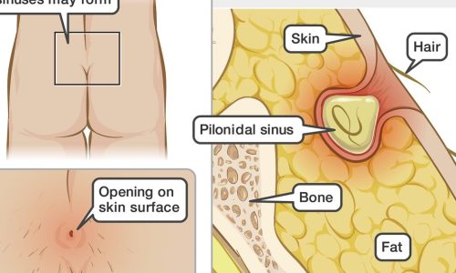 IMD_pilonidal_sinus_EN