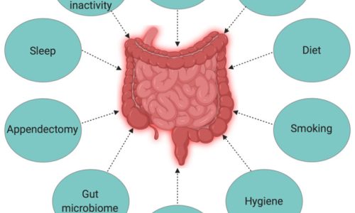 The-interplay-of-factors-causing-inflammatory-bowel-disease-IBD