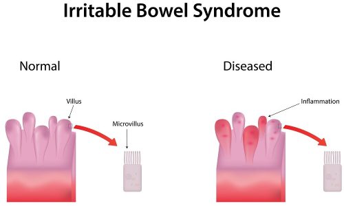 TreatmentofIBS