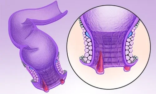 anal-fissure-2