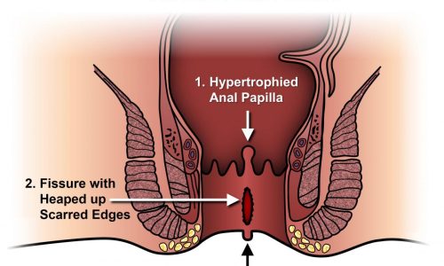 anal_fissure