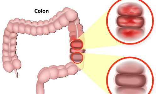 topivert-ulcerative-colitis