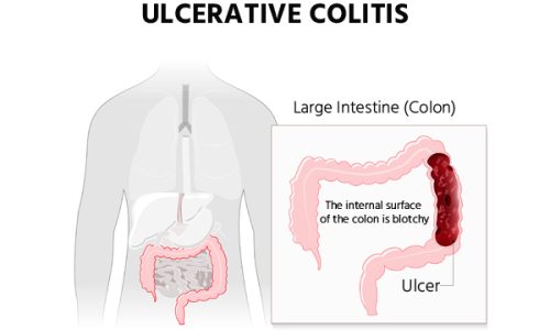 ulcerative-colitis